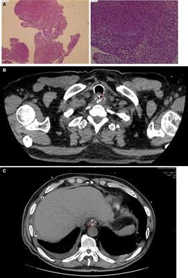 Case report: Drainage tube penetrating anastomosis as a rare cause for long-term nonunion of esophagogastric anastomosis in neck